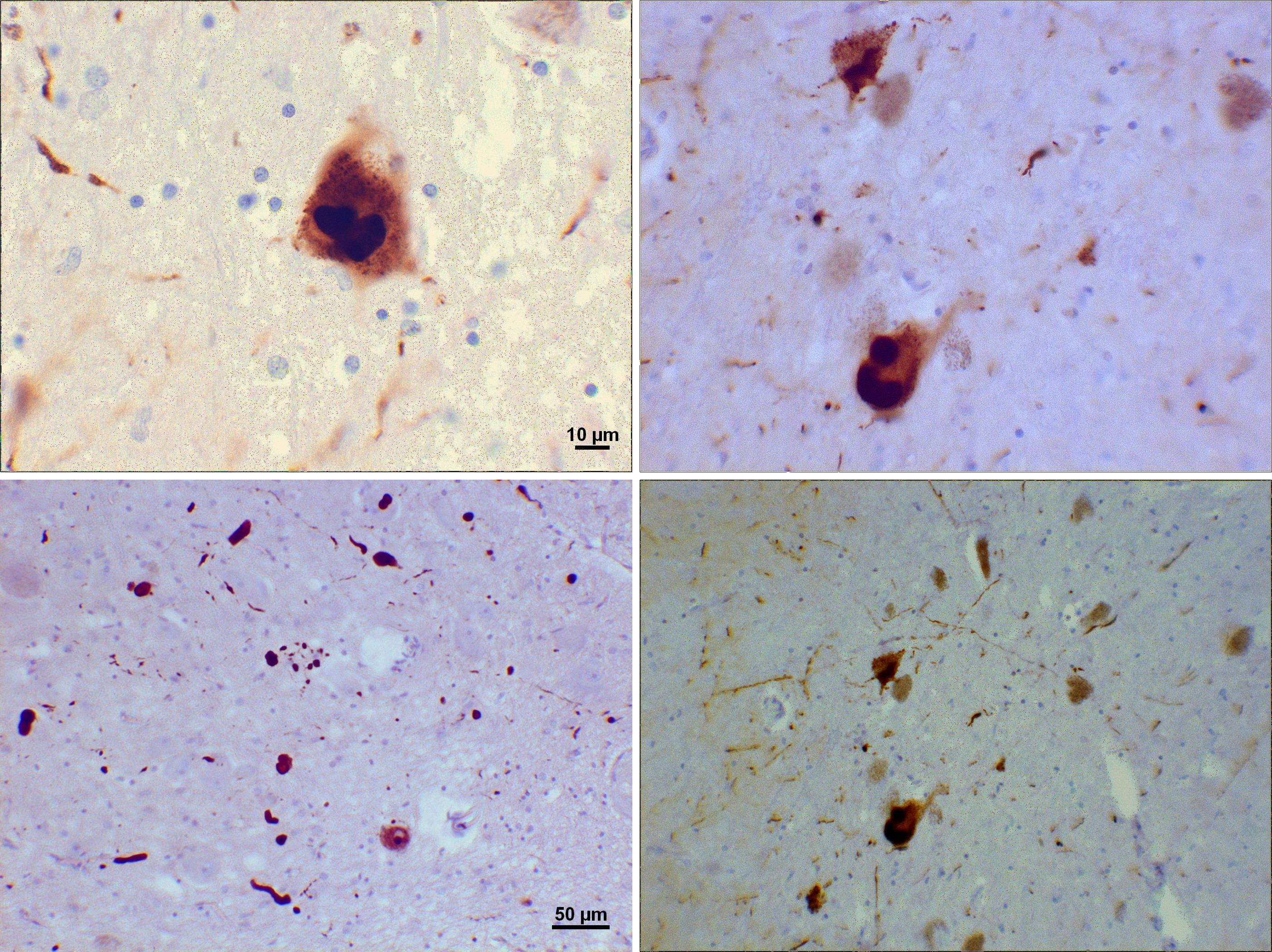 File:Lewy bodies (alpha synuclein inclusions).jpg