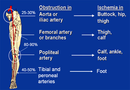 Sites of Claudication. Adapted from TCT 2005