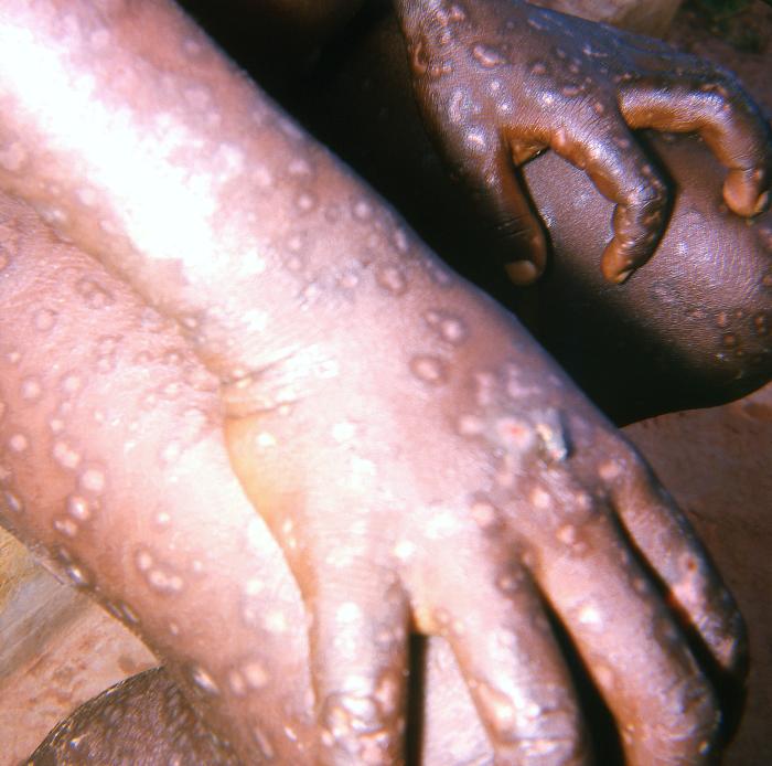 Hands, and knee region of both legs of a smallpox patient, displaying the characteristic maculopapular rash due to this viral disease.Adapted from Public Health Image Library (PHIL), Centers for Disease Control and Prevention.[3]