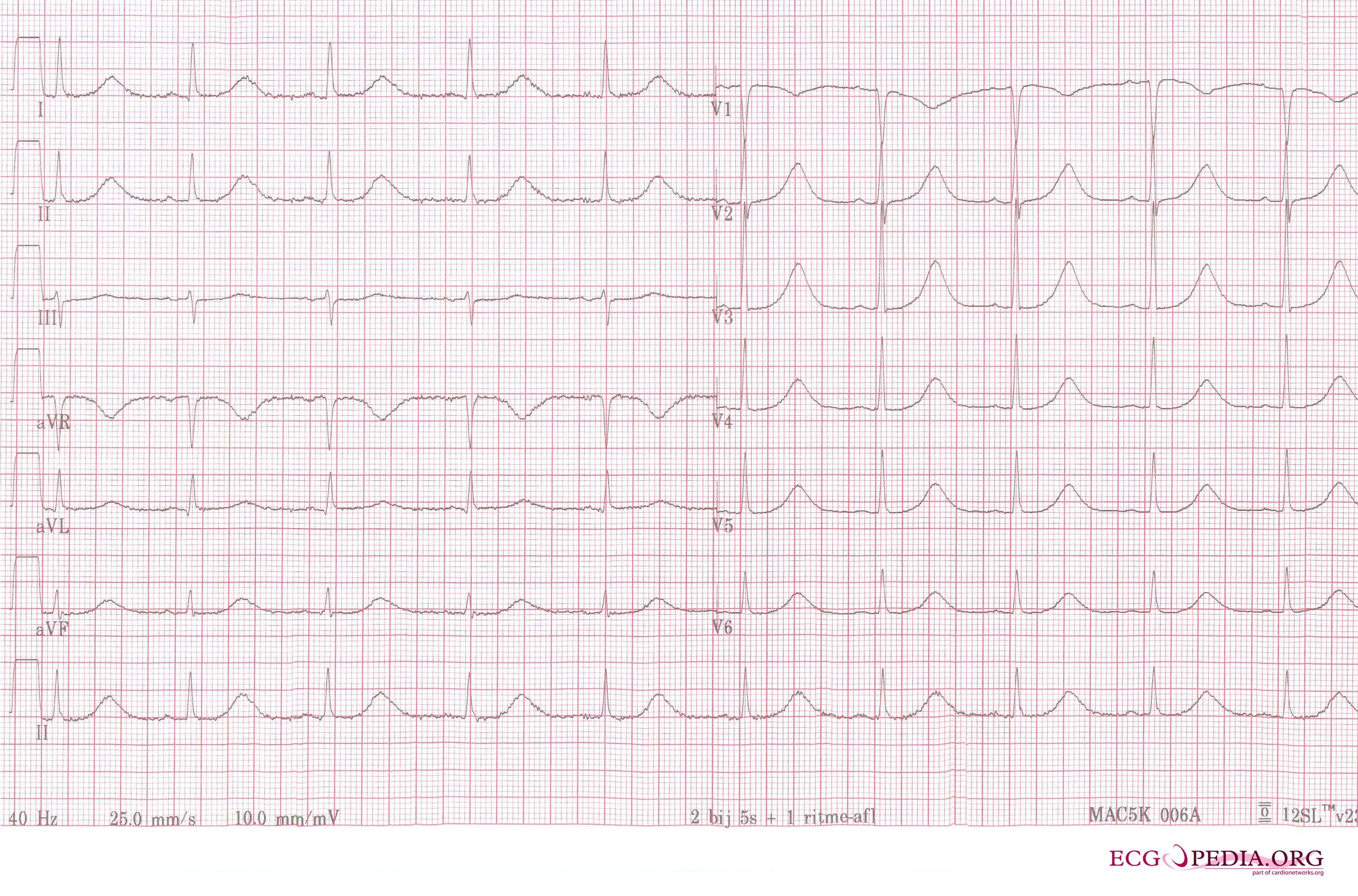 A 12 lead ECG of a patient with acquired long QT syndrome. Notice the QT prolongation. The QTc is about 640ms.