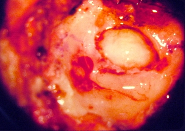 This cholesteatoma sac has eroded the lateral surface of the mastoid bone and was found immediately under the post-auricular skin.[5]