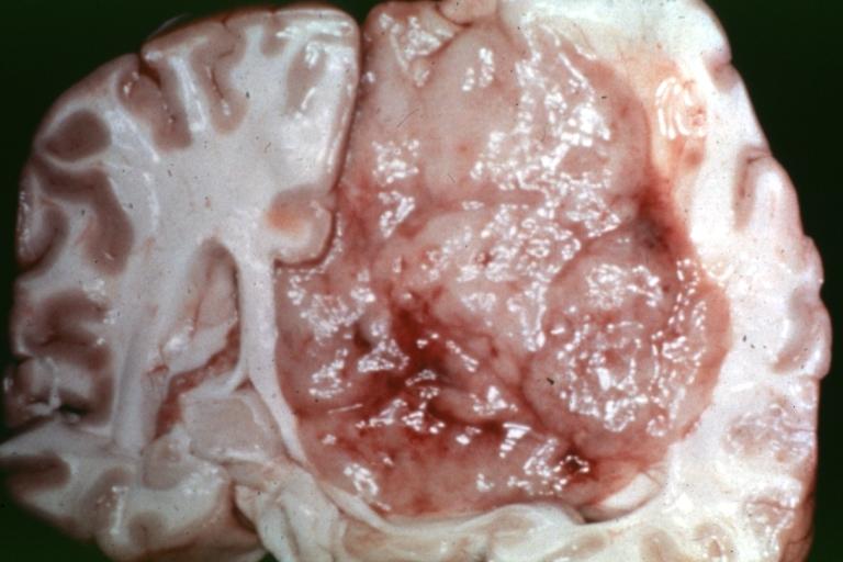 Brain: Oligodendroglioma: Gross; natural color, coronal section, cerebral hemispheres, large lesion, left parieto occipital white matter