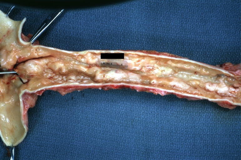 Atherosclerosis: Gross, good example of plaques in aorta