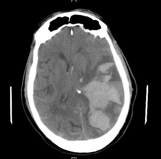 Very large intracerebral haemorrhage on the left extends to involve the ventricles. It exerts marked mass effect