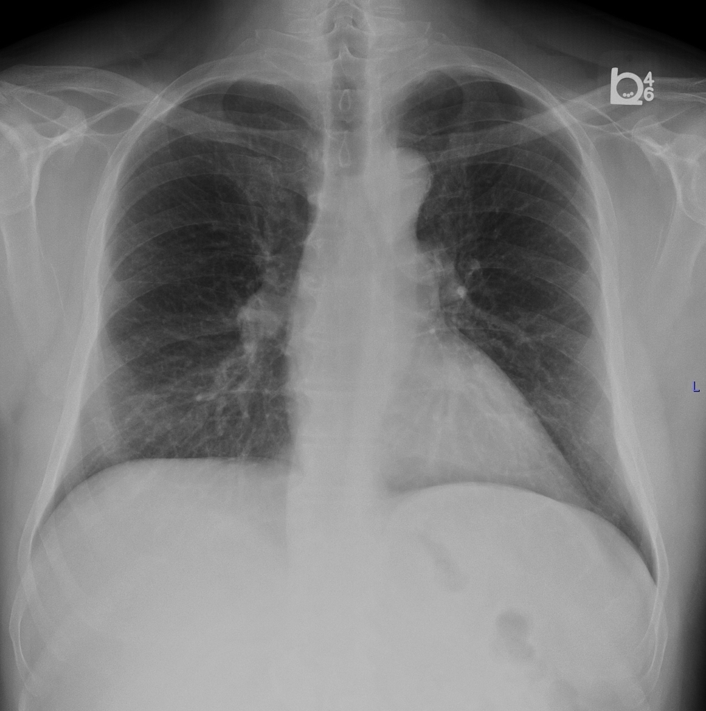 CXR of a patient came for evaluation for left sided pleural effusion with possible asbestos exposure demonstrates very subtle left sided pleural thickening.<ref name=cxrimagemesothelioma1>Image courtesy of Dr. A.Prof Frank Gaillard. Radiopaedia (original file here). Creative Commons BY-SA-NC