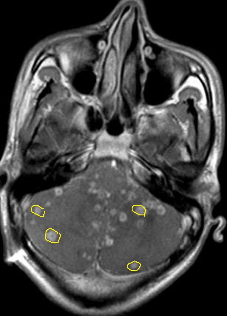 File:Posterior-fossa-neurocysticercosis-1.JPG