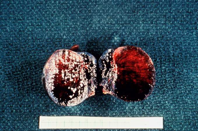 This is a gross photograph of cut section of testis from previous image. The tissue is filled with blood.