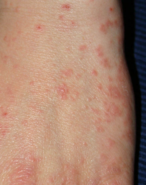 Scabies on the Hand