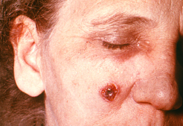 "Anthrax, skin of face, 11th day”Adapted from Public Health Image Library (PHIL), Centers for Disease Control and Prevention.[20]