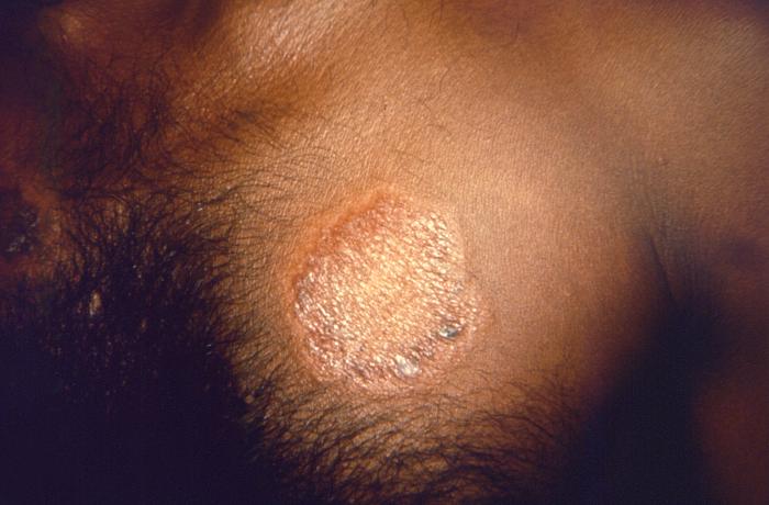 Tubercular or paucibacillary leprosy, with asymmetrically-distributed solitary skin lesion. Adapted from Public Health Image Library (PHIL), Centers for Disease Control and Prevention.[6]