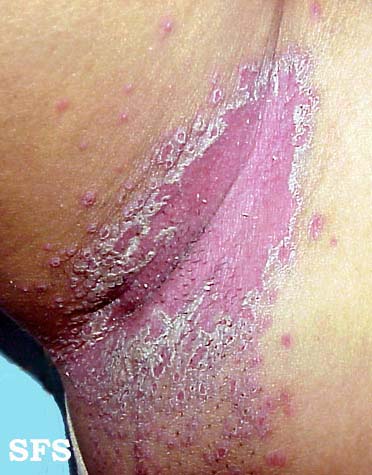 Candidiasis. Adapted from Dermatology Atlas.[62]