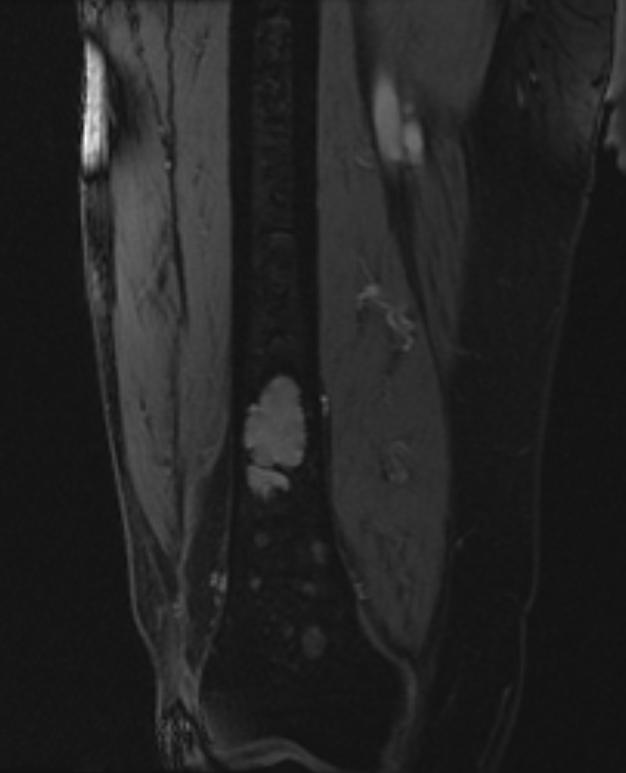 File:Multiple myeloma MRI103.jpg