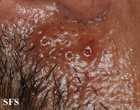 Nodular amyloidosis. Adapted from Dermatology Atlas.<ref name="Dermatology Atlas">{{Cite