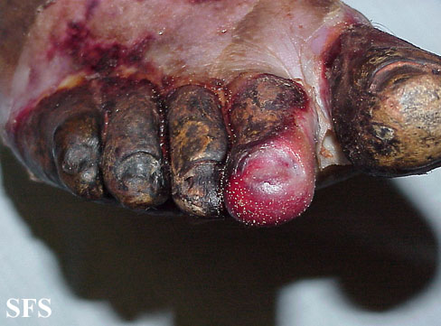 Peripheral occlusive arterial disease. With permission from Dermatology Atlas.[1]