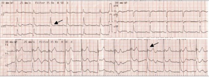 Same patient's post treatment EKG. Faster sinus rhythm with smaller Osborn waves. [16]