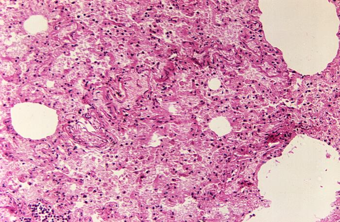 Hematoxylin-eosin stained lung tissue sample revealed the histopathologic changes indicative of what was diagnosed as a case of fatal human plague from the country of Nepal (125x mag). From Public Health Image Library (PHIL). [19]