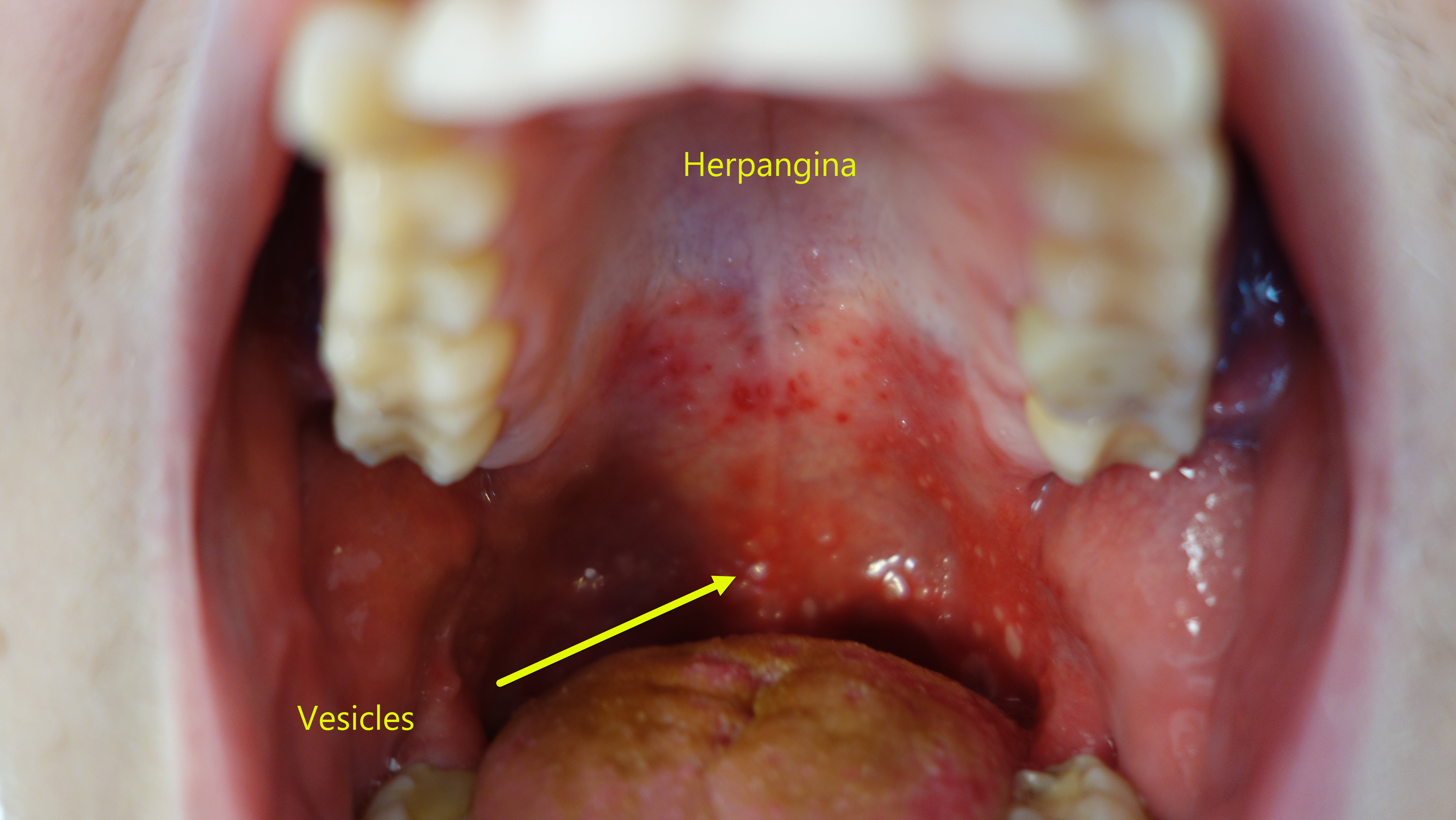 Erythema, vesicles and ulcerating lesions in herpangina
