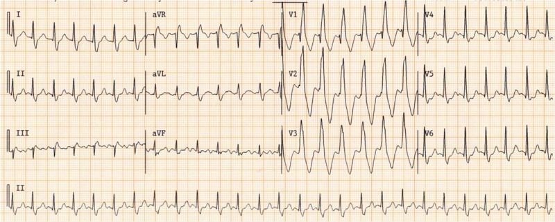 Wide complex tachycardia. No AV dissociation. RBBB. Resembles sinus rhythm from the same patient. Conclusion: SVT with RBBB
