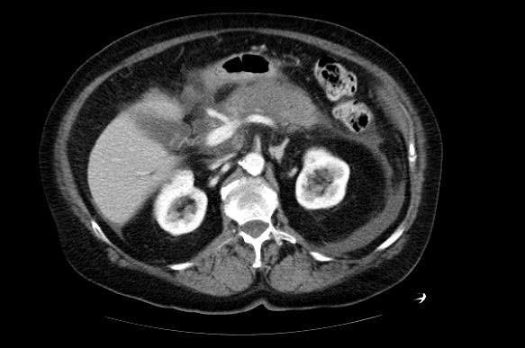 File:Gallstone-pancreatitis-002.jpg