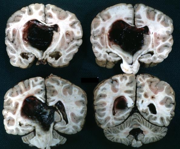 Brain: Glioma Thalamic Grade Ii-Iii: Gross; fixed tissue, four coronal sections, cerebral hemispheres, very large hemorrhagic lesion