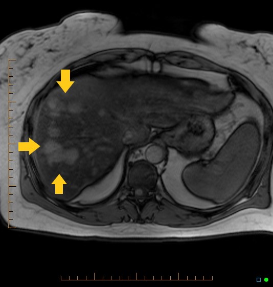 File:Hepatic Adenoma MRI.jpg