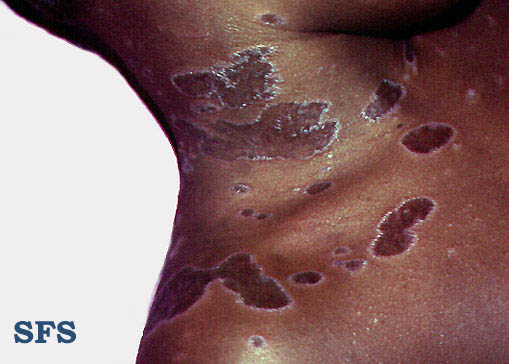 Lichen planus annular. Adapted from Dermatology Atlas.[1]