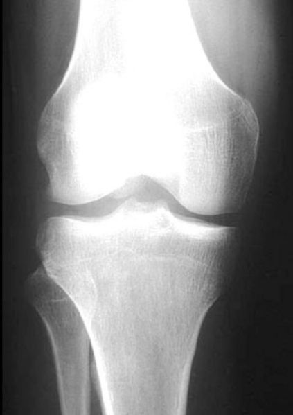 File:Segond-fracture-with-ACL-tear-001.jpg