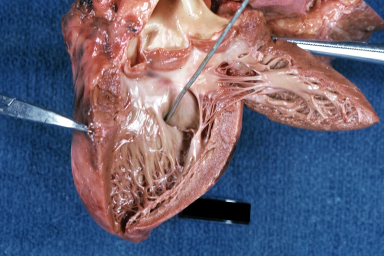 Ventricular Septal Defect Muscular: Gross, natural color, view from right ventricle with probe in defect right ventricular hypertrophy is evident