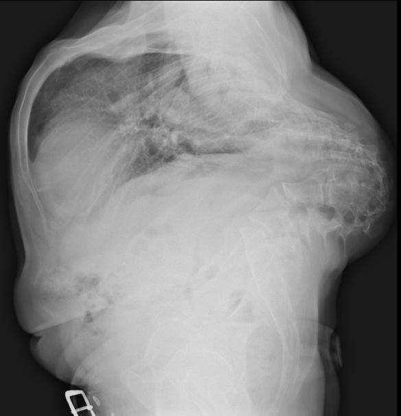 Chest x-ray: A 53 years old patient with severe kyphosis