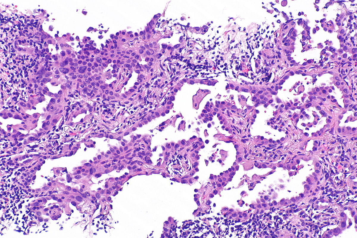 Micrograph of mucinous adenocarcinoma of the lung. H&E stain.