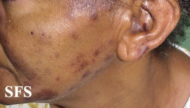 Subacute cutaneous lupus erythematosus. Adapted from Dermatology Atlas.[2]