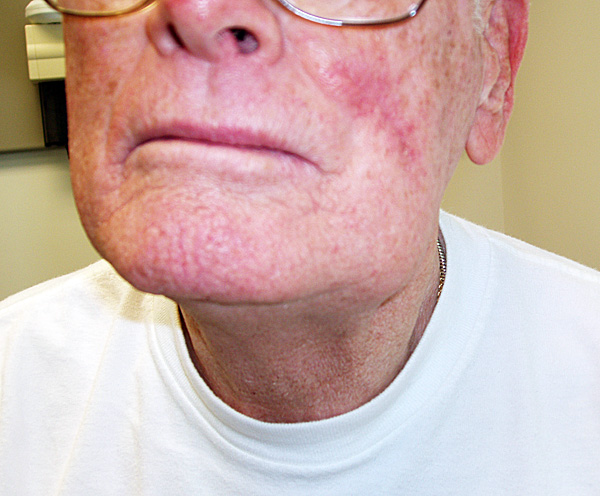Squamous Cell Cancer of the Mouth: Cancer that originated along the lower gum line, leading to spread along the left submandibular lymph nodes.