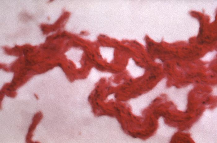 Under a high magnification of 1000X, Ziehl-Neelsen stained mycobacterial culture specimen reveals numerous acid-fast bacilli displaying morphologic phenomenon known as "cording".Adapted from Public Health Image Library (PHIL), Centers for Disease Control and PreventionPublic Health Image Library (PHIL), Centers for Disease Control and Prevention[19]