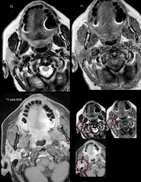 MRI showing parotid adenocarcinoma[5]