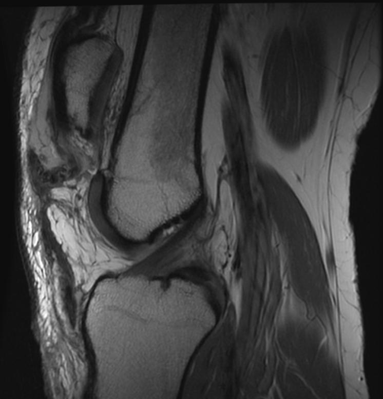 MRI: Patella alta secondary to patellar tendon rupture