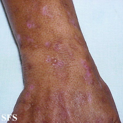 Porphyria cutanea tarda. With permission from Dermatology Atlas.[2]