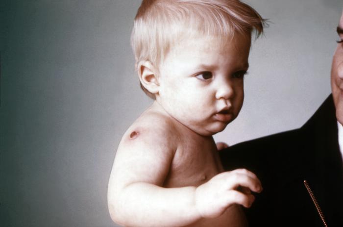 Face and right shoulder of a young child after receiving a smallpox vaccination in the right shoulder region. Note the erythematous halo surrounding the vaccination site. The morbilliform skin rash, i.e., resembling measles,consists of numerous flattened erythematous, amorphous macules.Adapted from Public Health Image Library (PHIL), Centers for Disease Control and Prevention.[3]