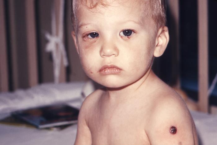 Post-smallpox vaccination complication, this 21 month-old male infant developed secondary facial vaccinial infection involving both eyes and bilateral periorbital areas.Adapted from Public Health Image Library (PHIL), Centers for Disease Control and Prevention.[3]