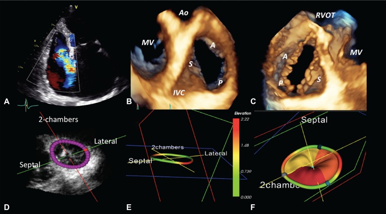 File:Three-dimensional echocardiography.jpg