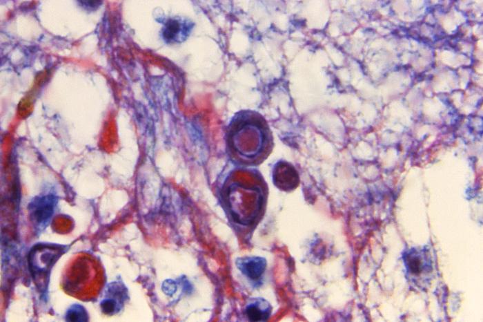 Hematoxylin-eosin (H&E)-stained photomicrograph reveals some of the cytoarchitectural histopathologic changes found in a human skin tissue specimen that included a varicella zoster virus lesion (1200x mag). From Public Health Image Library (PHIL). [7]