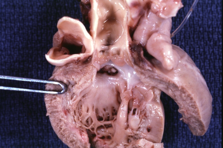Perimembranous Ventricular Septal Defect: Gross, fixed tissue, opened left ventricular outflow tract into aorta. Defect was patched 3 days prior to death