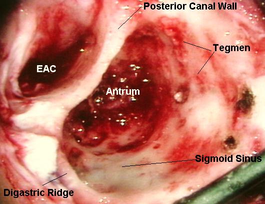 Picture of a left mastoidectomy, surgeon's view.[2]