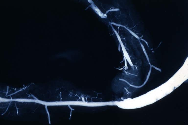 Angiogram Saphenous Vein Bypass Graft: X-ray shows rather close-up large vein anastomosing to much smaller artery