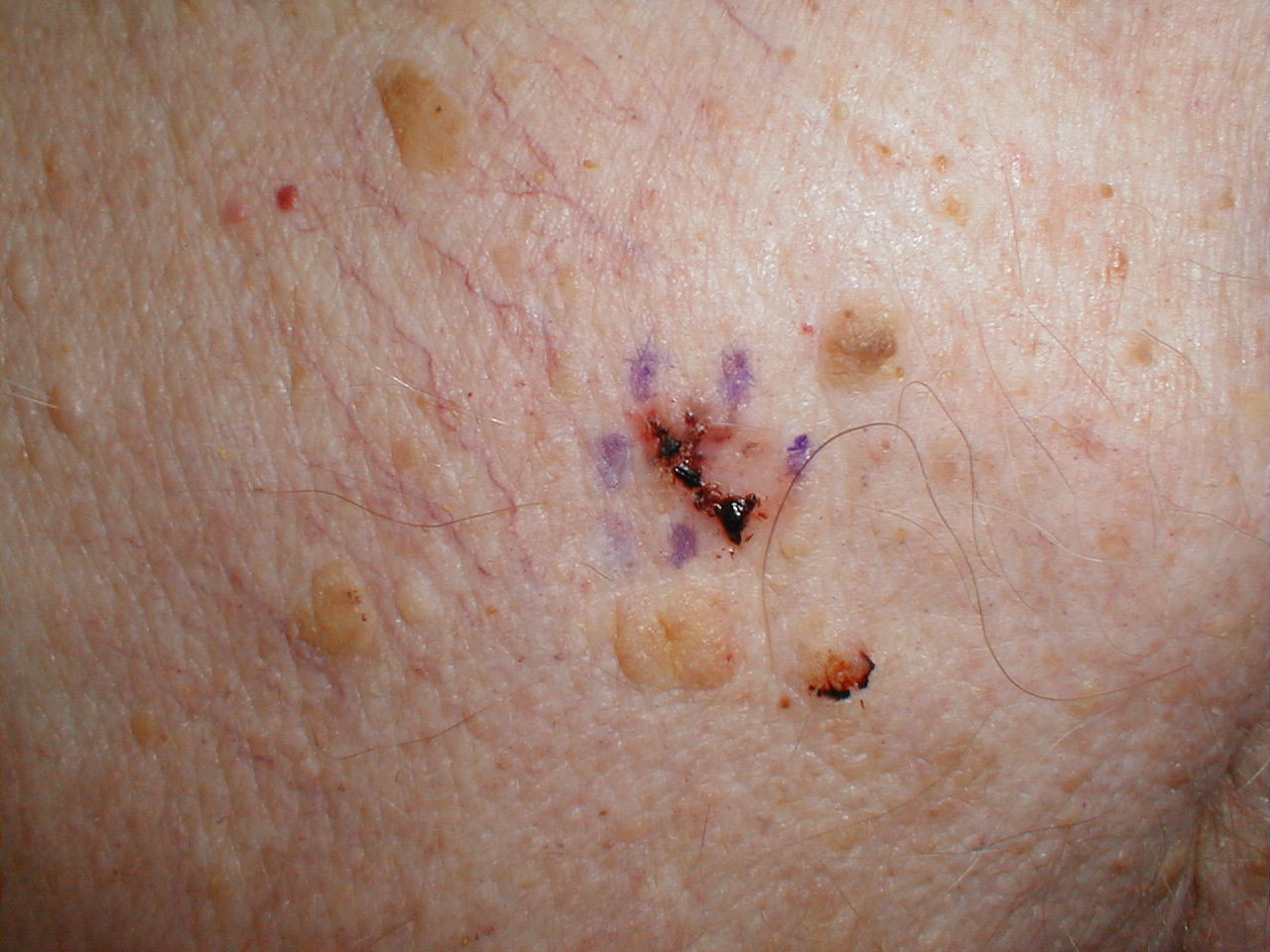 Basal cell carcinoma (pigmented)
