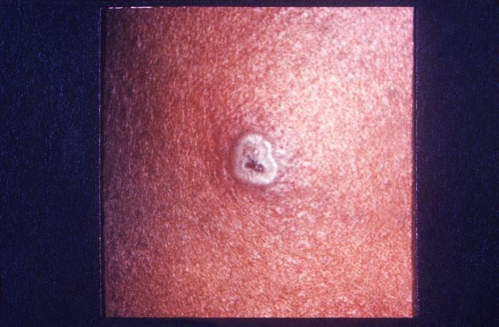 This image depicts the smallpox vaccination site, which in the case of this recipient, displayed a reaction after a period of seven days.Adapted from Public Health Image Library (PHIL), Centers for Disease Control and Prevention.[3]