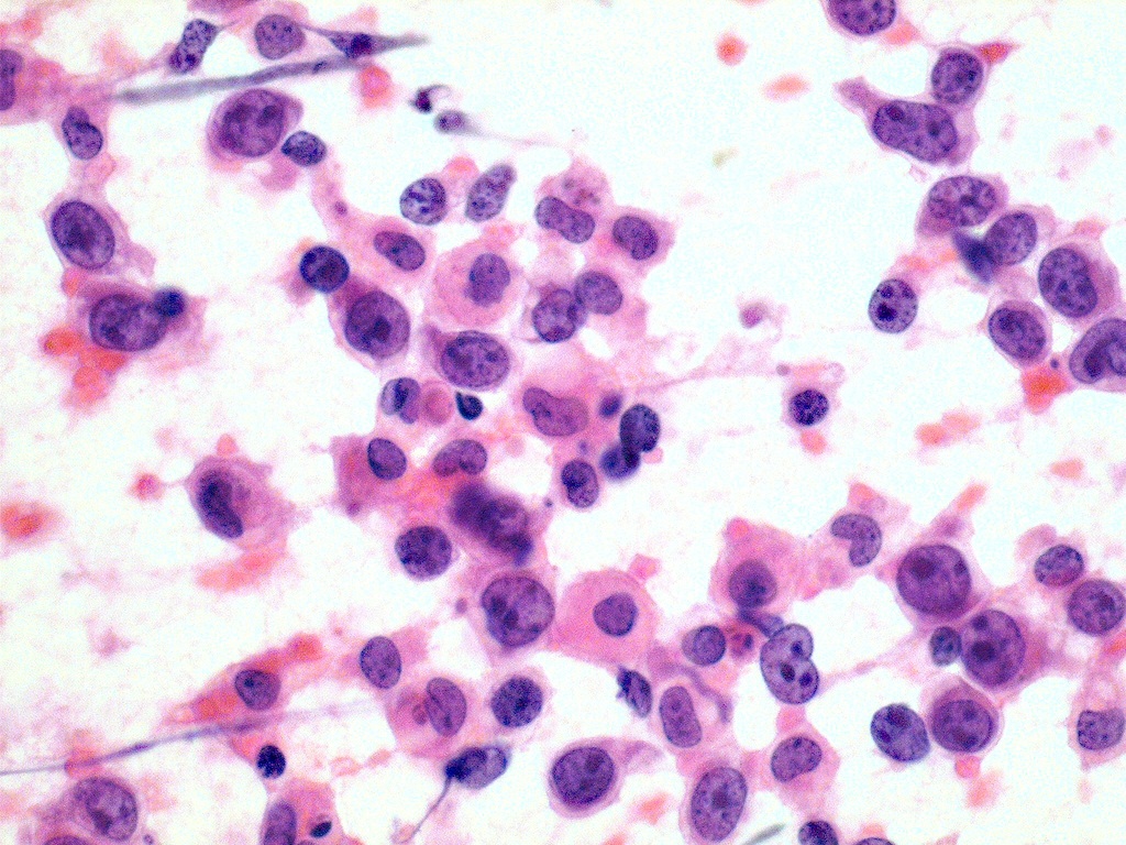File:Thyroid lymphoma large cell type fine needle aspiration biop.jpeg