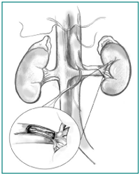 Illustration of renal artery stenosis