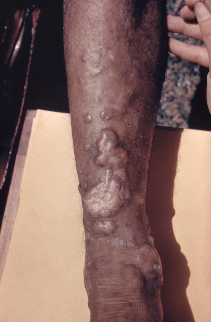 Morphologic changes that took place upon a patient’s arm, which included keloidal scarring brought on due to a case of cutaneous blastomycosis, caused by Blastomyces dermatitidis. From Public Health Image Library (PHIL). [2]