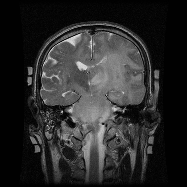 Coronal T2 gliomatosis cerebri MRI.[3]