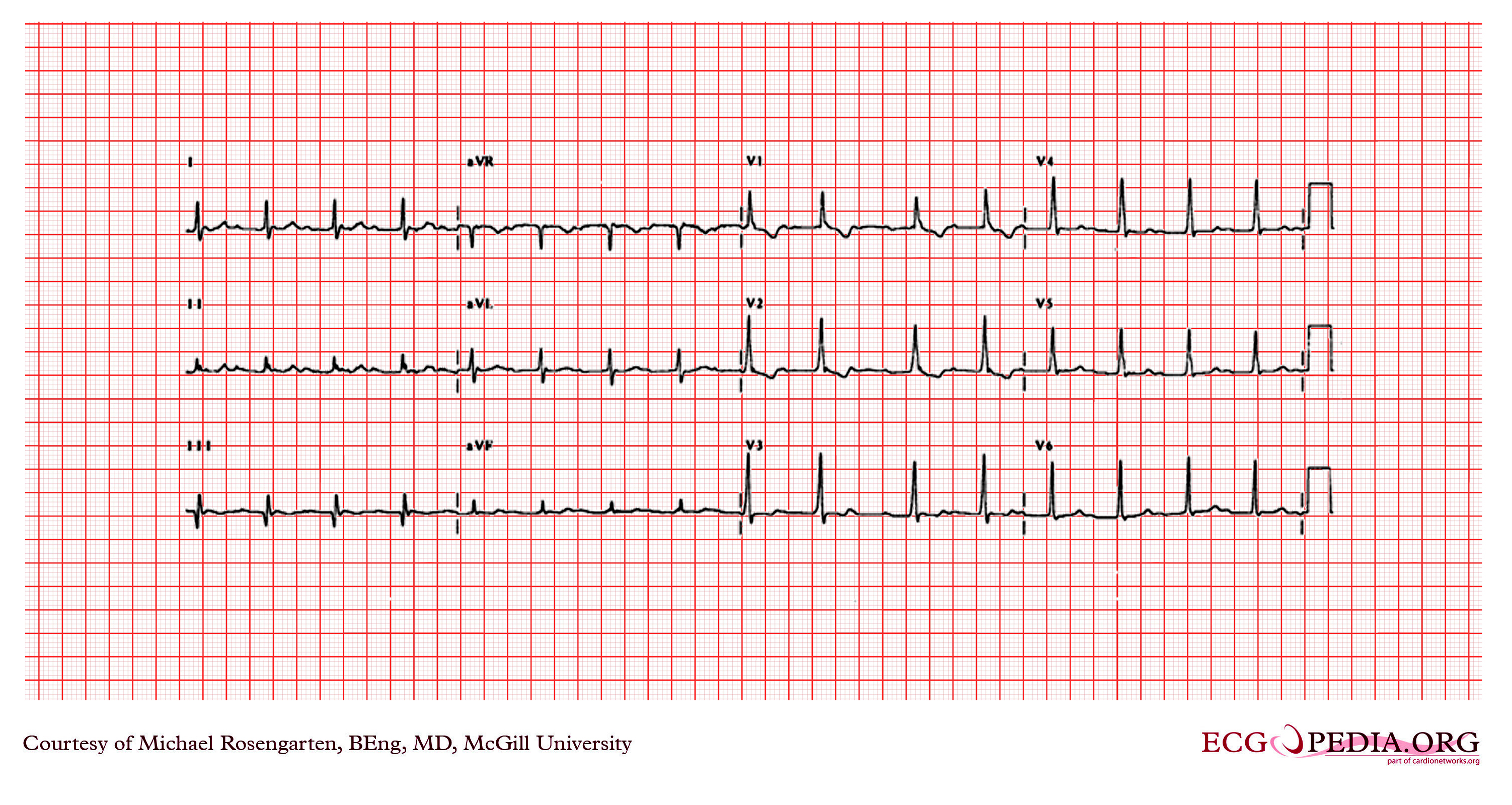 File:Wide complex tachycardia2.jpg